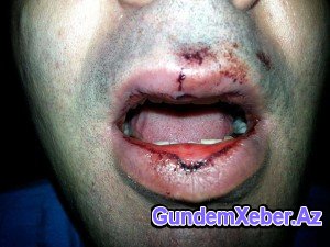Gənc alimi vəhşicəsinə döyən şəxs hansı vəzifəli polisin oğludur? - Fotolar (Özəl)
