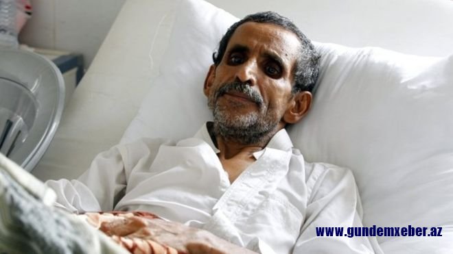 BMT: Yəməndə dünyanın ən dəhşətli vəba epidemiyası tüğyan edir