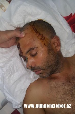 İzzət Bağırovun cangüdəni məclis sahibini beşbarmaqla bu hala salıb, amma tutulmayıb