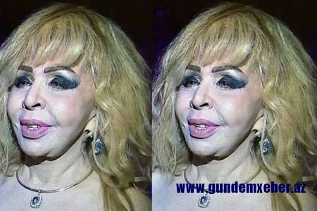 ​Azərbaycanlı müğənni tanınmaz hala düşdü - FOTO