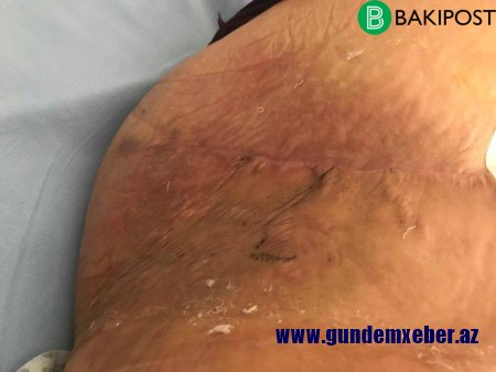 Baş həkimin əməliyyat etdiyi qadın dəhşətli durumda – İnfeksiya ətini yeyir/ FOTOLAR (16+)