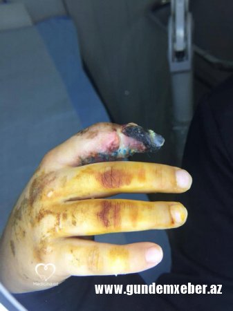 Plastik cərrah Vaqif Qələndərli 8 yaşlı uşağı şikəst edib? – (FOTOLAR)