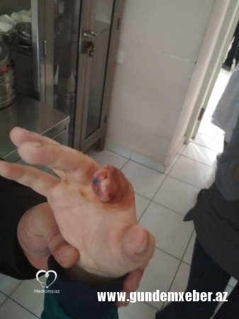 Plastik cərrah Vaqif Qələndərli 8 yaşlı uşağı şikəst edib? – (FOTOLAR)