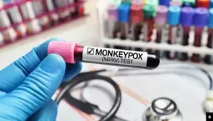 Ümumdünya Səhiyyə Təşkilatı Azərbaycana 3000 meymunçiçəyi test dəsti verib