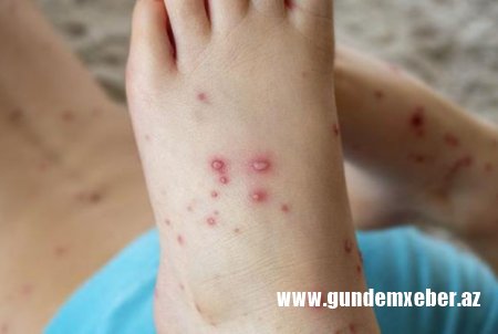 COVID-19 və meymunçiçəyi epidemiyası bitmədən yeni virus yayılır
