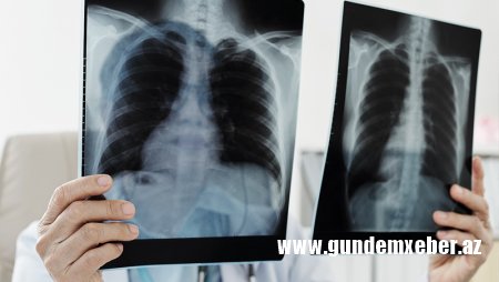 Çində yeni təhlükəli virus yayılıb? - Həkimdən açıqlama