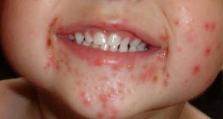 Azərbaycanda azyaşlılar arasında daha bir virus yayılıb - Video
