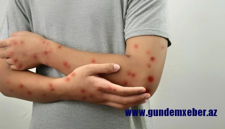 Meymunçiçəyi virusu dəyişir: Alimlər yeni mutasiya dalğasını aşkarladılar